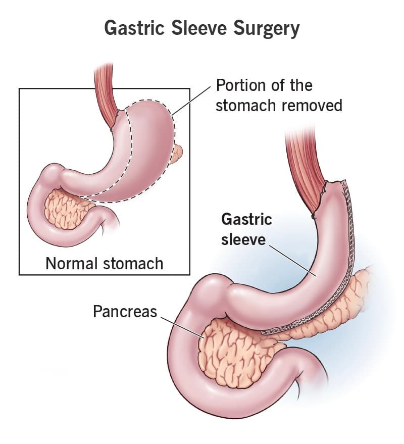 Gastric sleeve surgery anatomy diagram showing stomach reduction